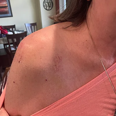 Laser Therapy