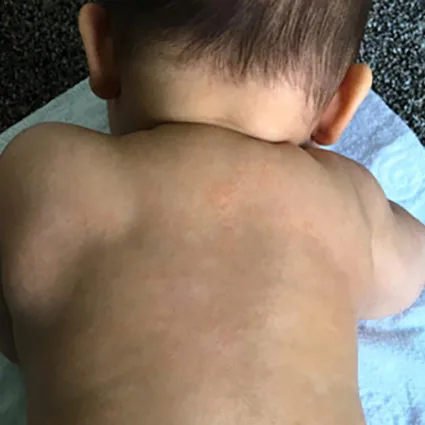 Clara after chiropractic care for eczema