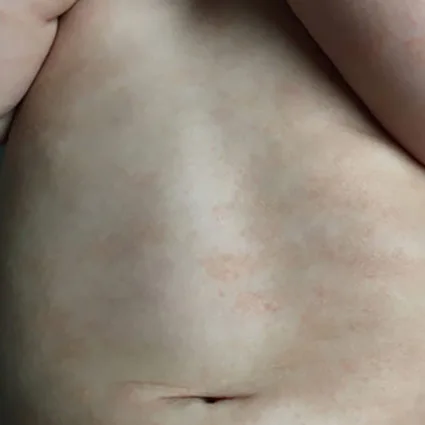 Clara before chiropractic care for eczema