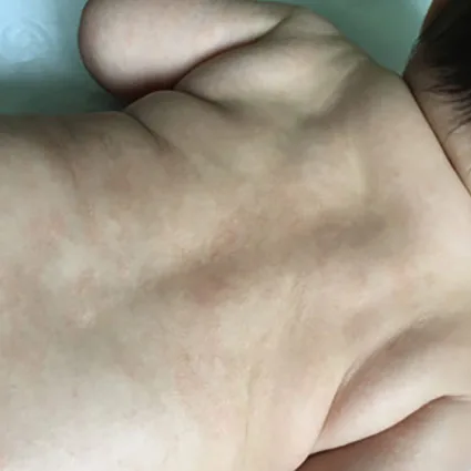 Clara before care with visible eczema irritation